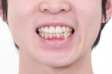 부산돌출입교정