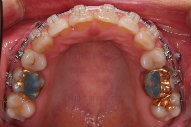 동래임플란트교정