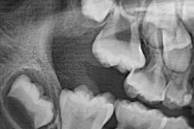 부산어린이치아교정