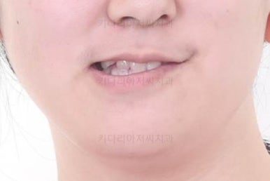 부산구순구개열