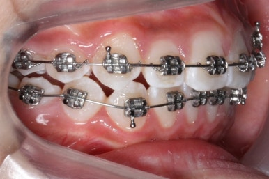 연산동덧니교정