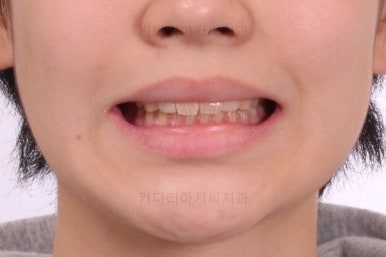 부산연산동치아교정