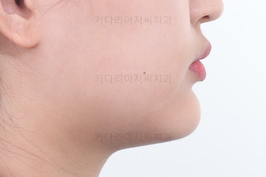 부산옥니교정
