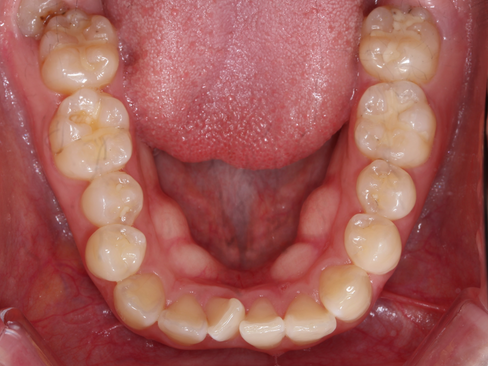 부산보철잘하는곳