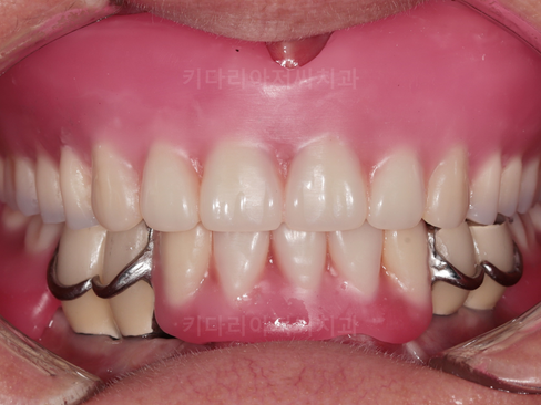 부산보험임플란트