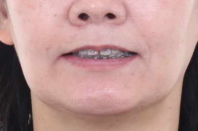 부산옥니교정