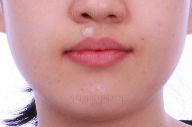 부산비발치교정