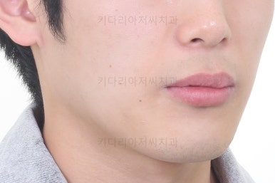 연산동치아교정