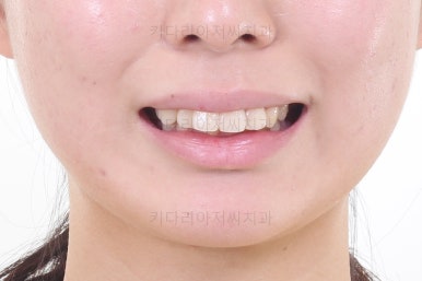 부산무턱교정치과