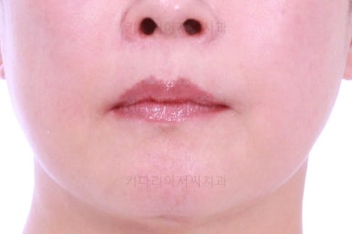 동래임플란트교정