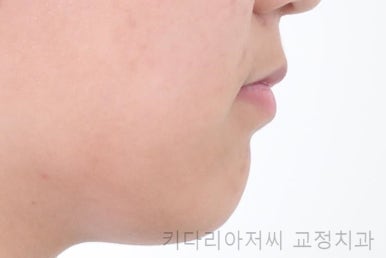 연산동치아교정