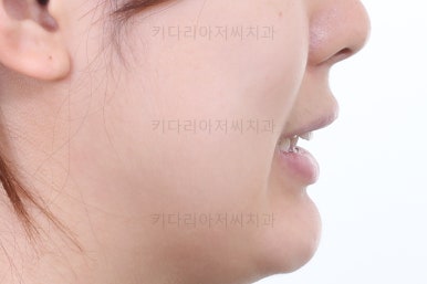 부산안면비대칭