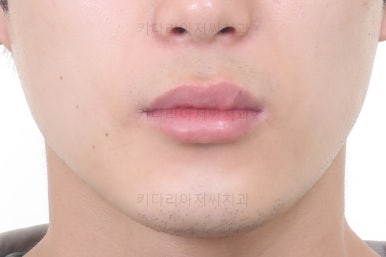 연산동치아교정