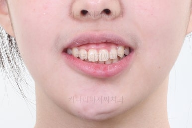 부산투명교정
