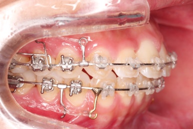 부산연산역치아교정