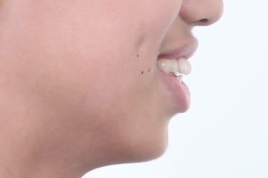부산치아교정전문의