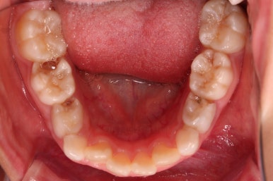 부산어린이반대교합