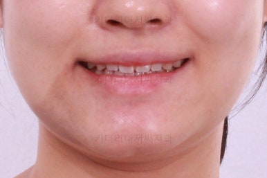 부산치아교정잘하는곳