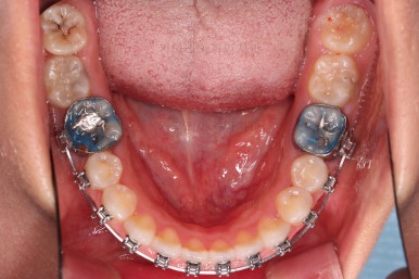 부산구순구개열