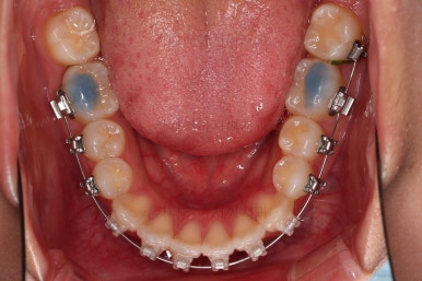 부산비발치교정