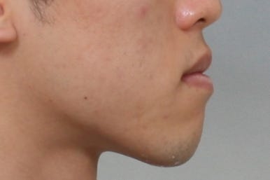 부산주걱턱교정