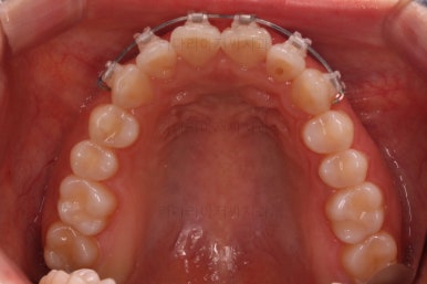 부산나비앞니교정