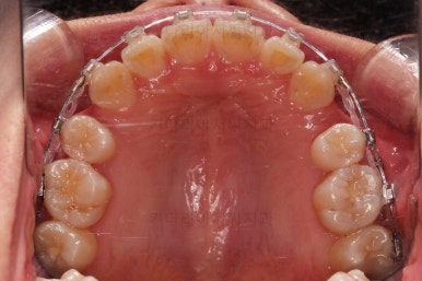 부산치아교정잘하는치과