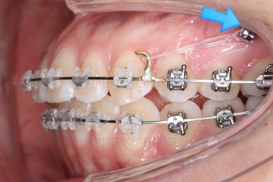 부산치아교정잘하는곳