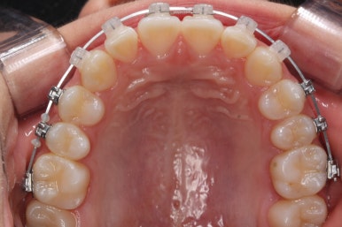 부산치아교정잘하는곳