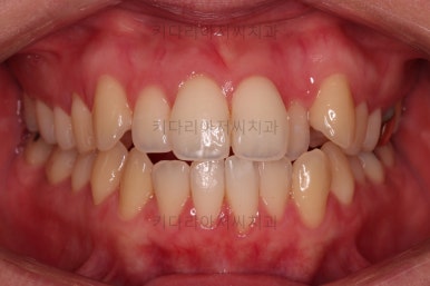 부산치아교정잘하는곳