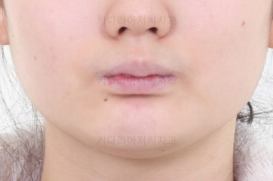 연산동치아교정