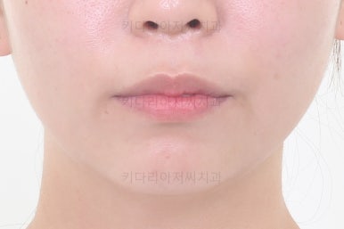 부산사랑니교정