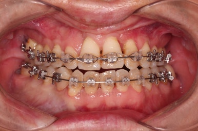 부산구순구개열교정