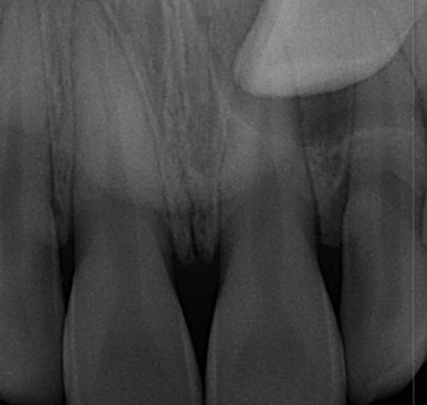 부산매복치아교정