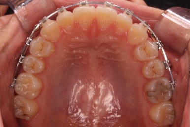 부산치아교정잘하는곳