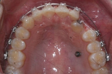 부산매복치아교정