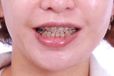 부산연산동교정치과