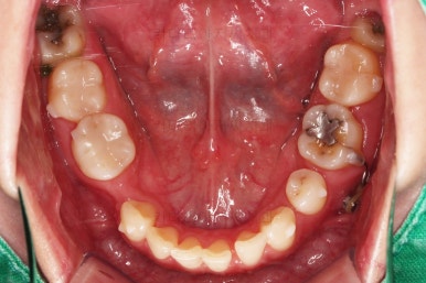 부산인비절라인