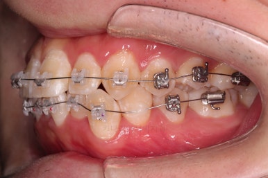 부산돌출입교정