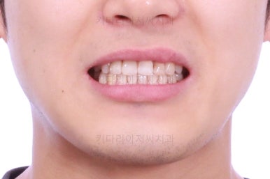 연산동치아교정