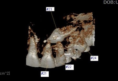 부산매복치아교정