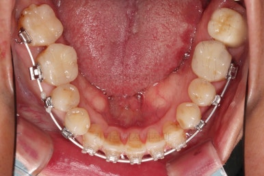 부산구순구개열교정