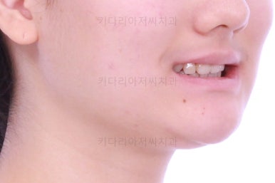 연산동치아교정