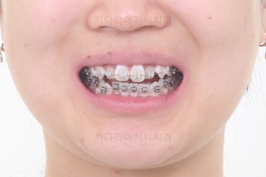 부산치아교정치과