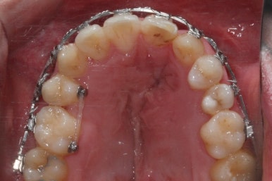 부산구순구개열