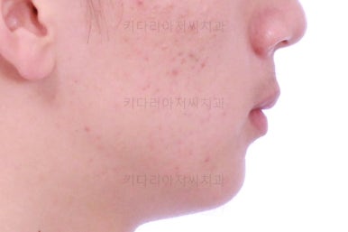 부산청소년치아교정