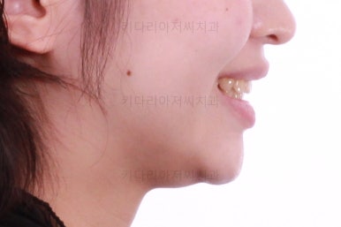 부산돌출입교정