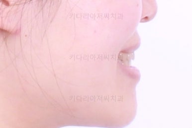 부산치아교정추천