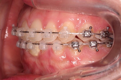 부산교정치과추천