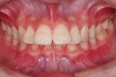 연산동치아교정
